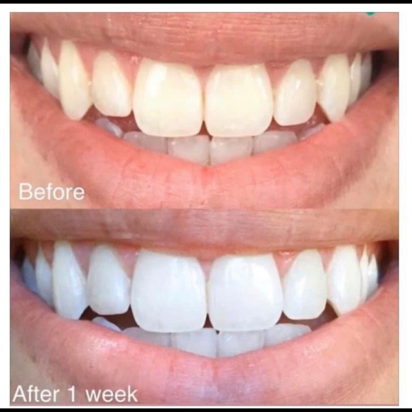Whitening Toothpaste 🦷 - Picture 5 of 8